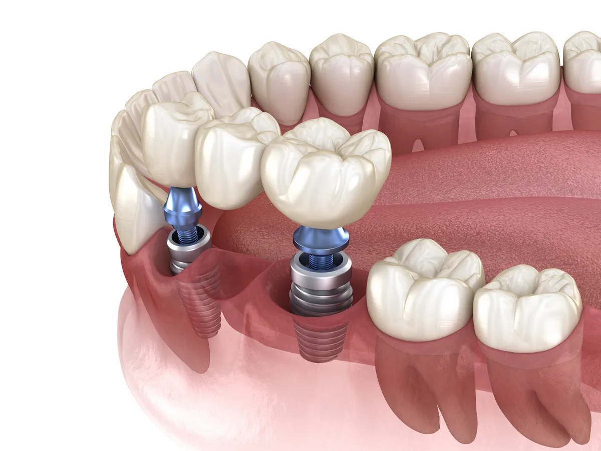 Co to jest implant dentystyczny?