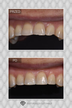 Widok przednich górnych zębów przed i po wykonaniu bondingu